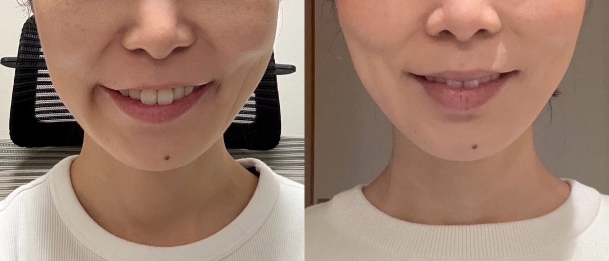 ご生徒様のビフォーアフター(口元・フェイスライン)