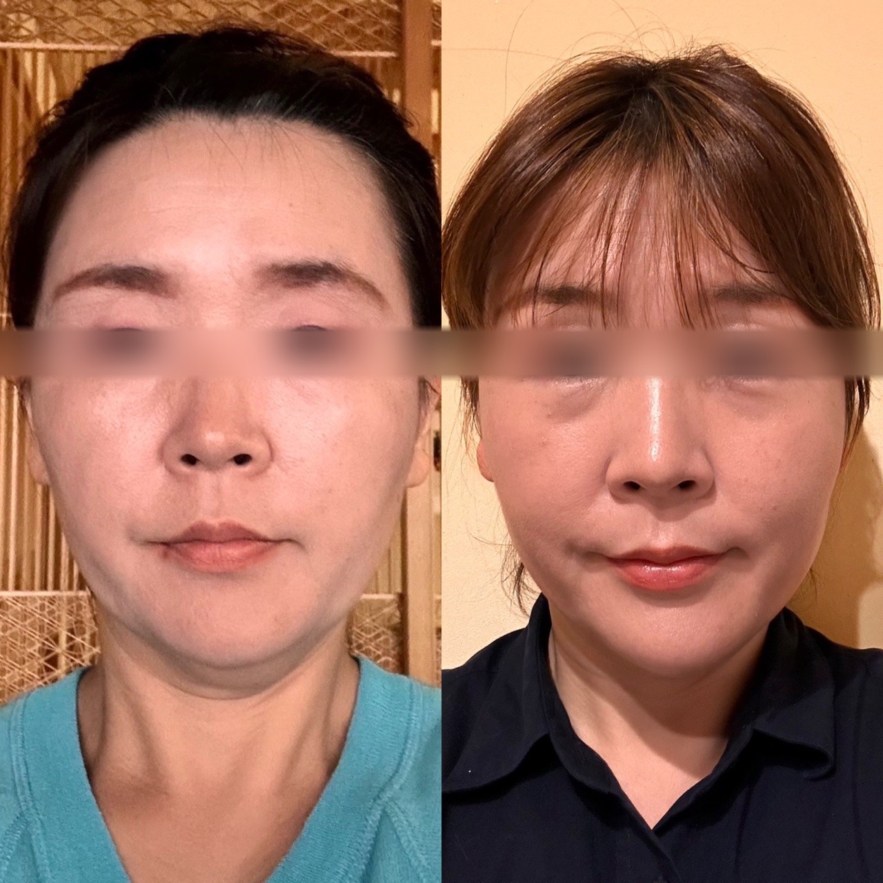 ご生徒様C様の全顔ビフォーアフター(瞳をぼかして掲載)